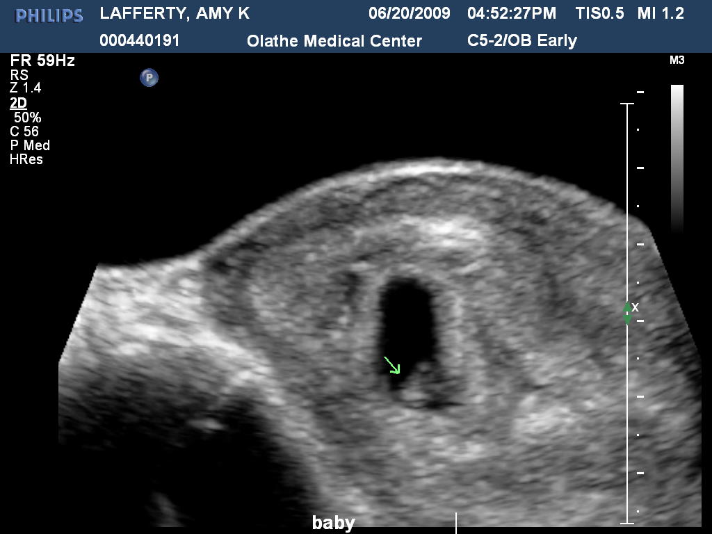Baby Lafferty's First Picture!!!